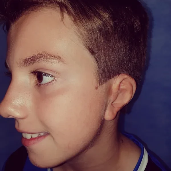 Young patient with reconstructed ear — microtia surgery result