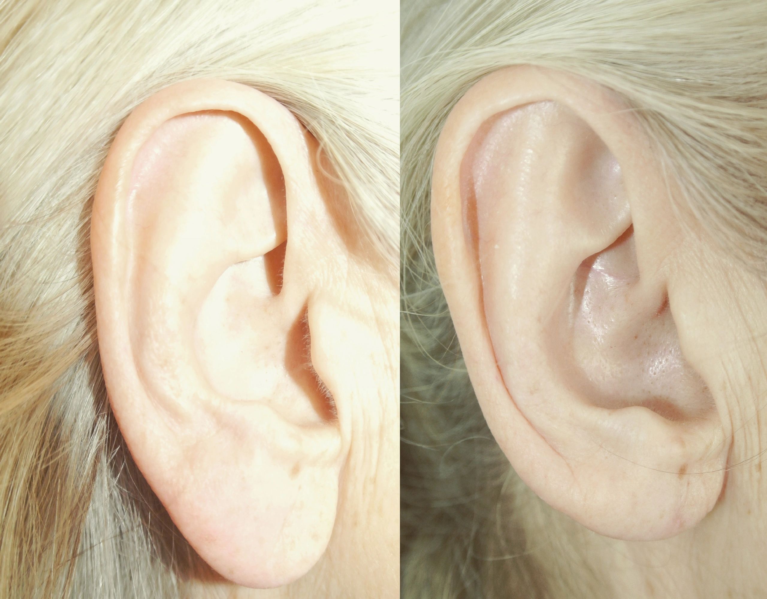 Ear surgery result