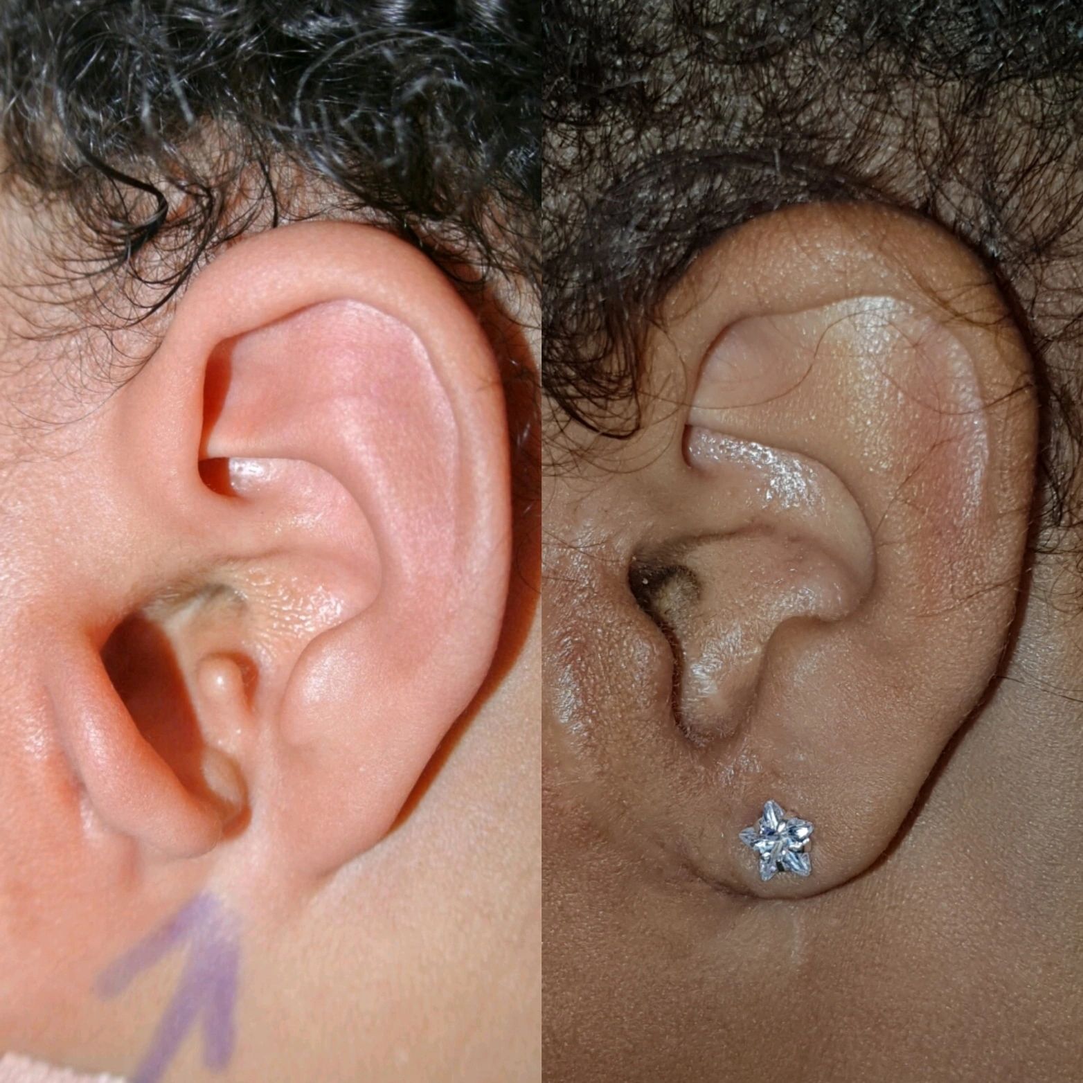 Ear surgery result