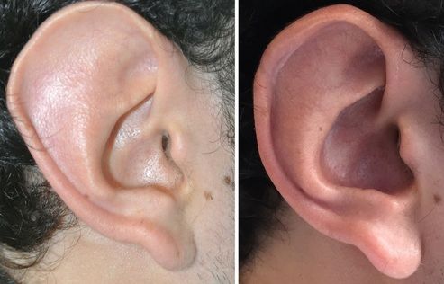 Ear surgery result