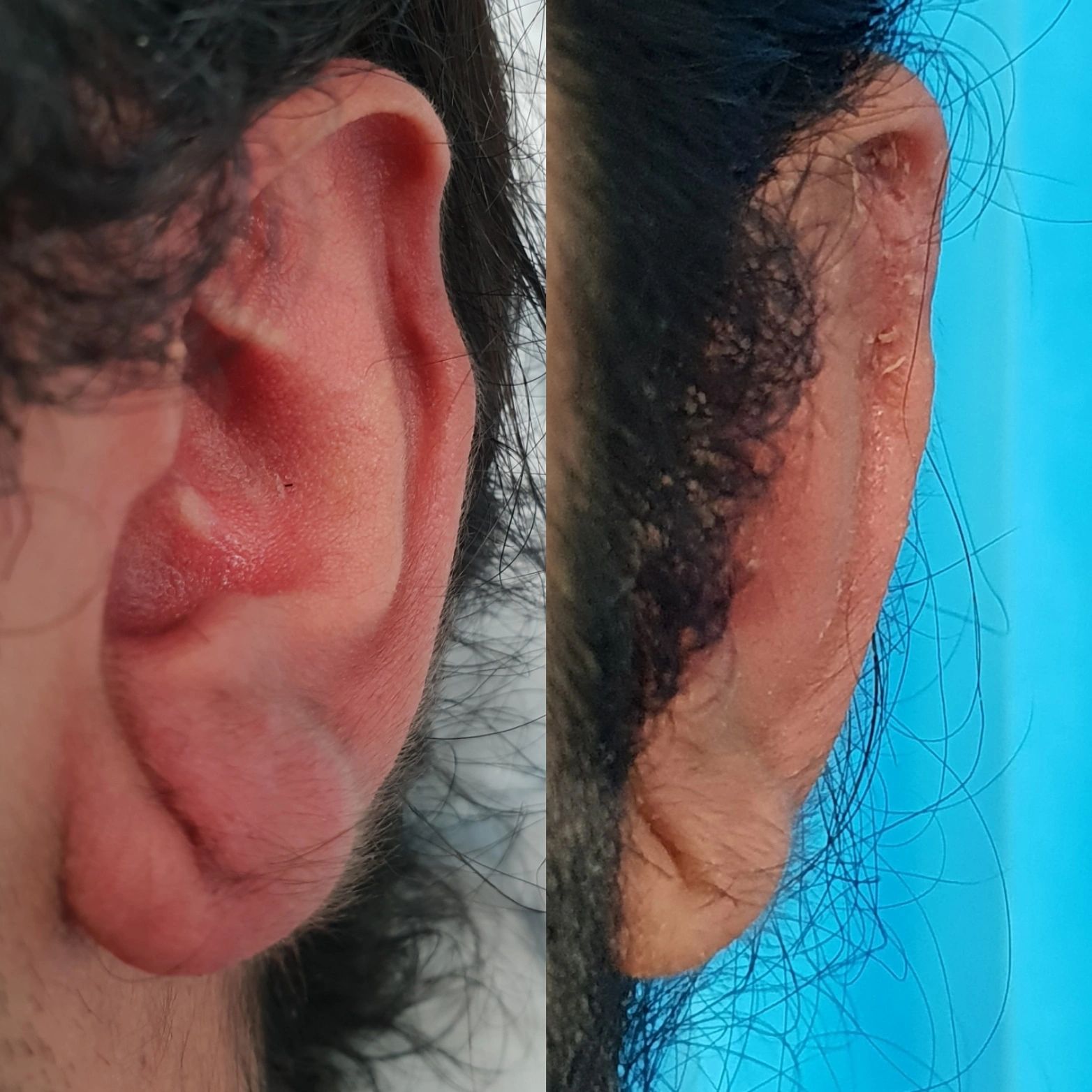 Ear surgery result
